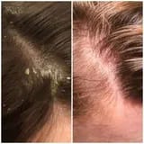 Customer photo review of Capilux™ — Exfoliante para un Cuero Cabelludo Limpio y Calmado