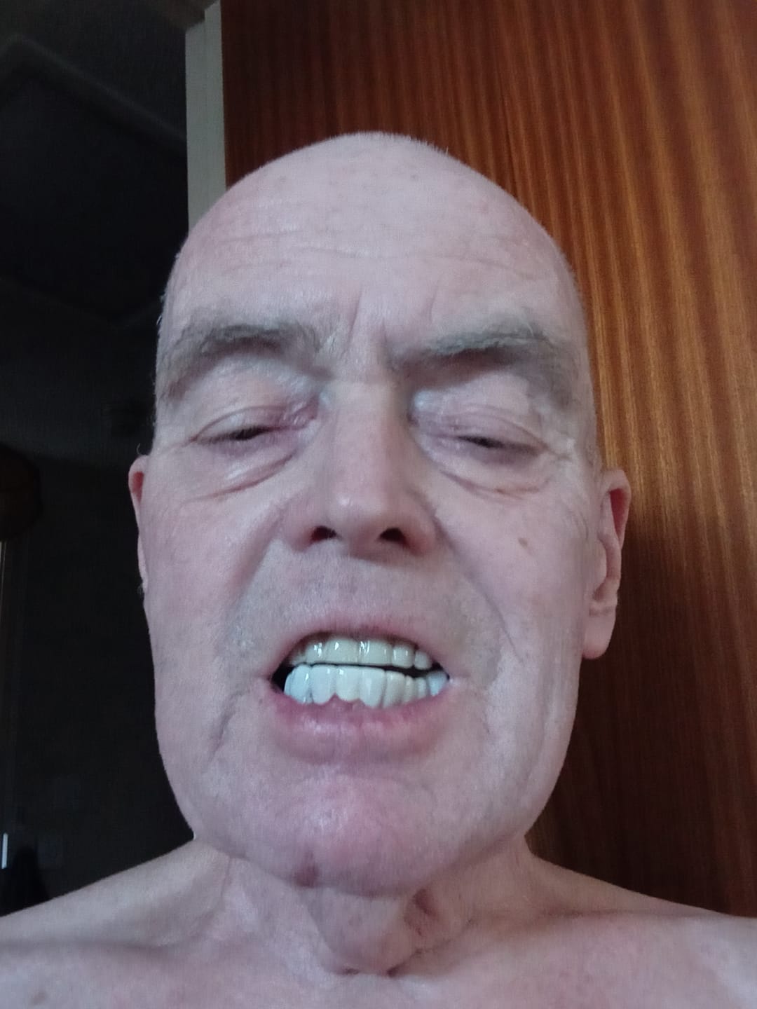 Customer photo review of Click-in Veneers 4.0
