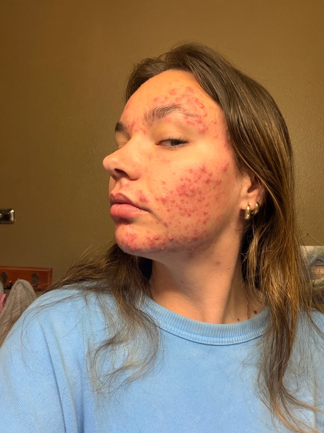 Customer photo review of The Complete System for Acne-Prone Skin