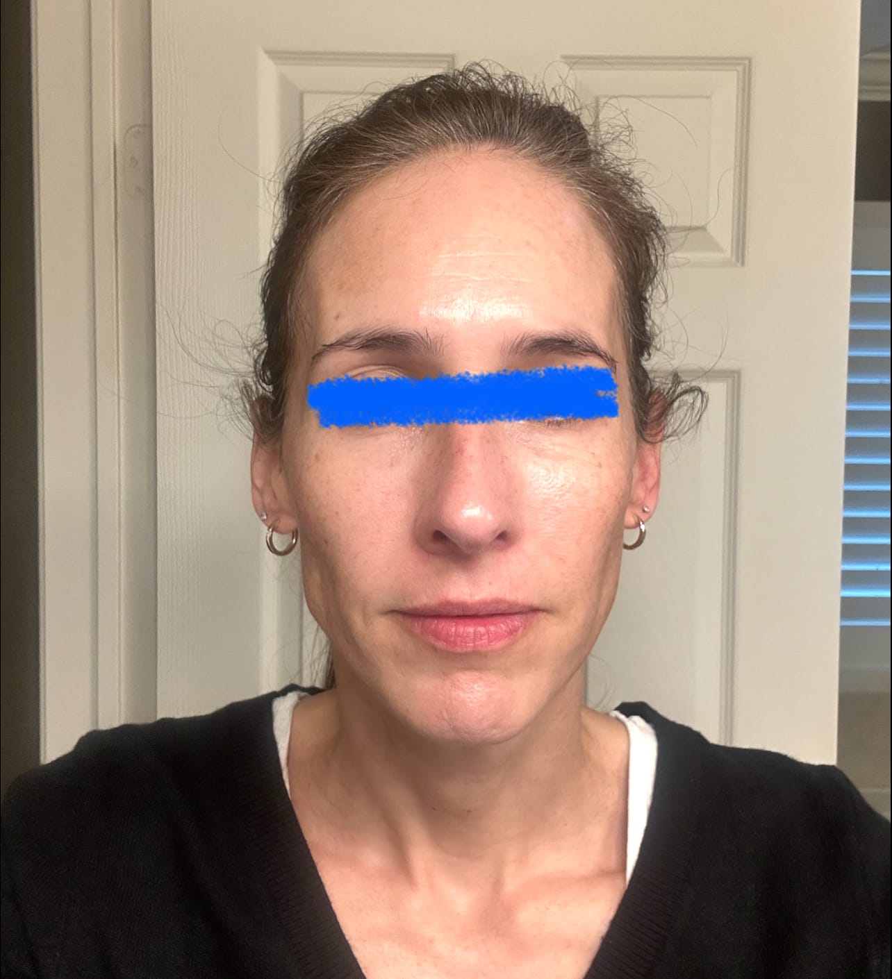Customer photo review of The Micro Infusion System™ Pigmentation For Melanin-Rich Skin