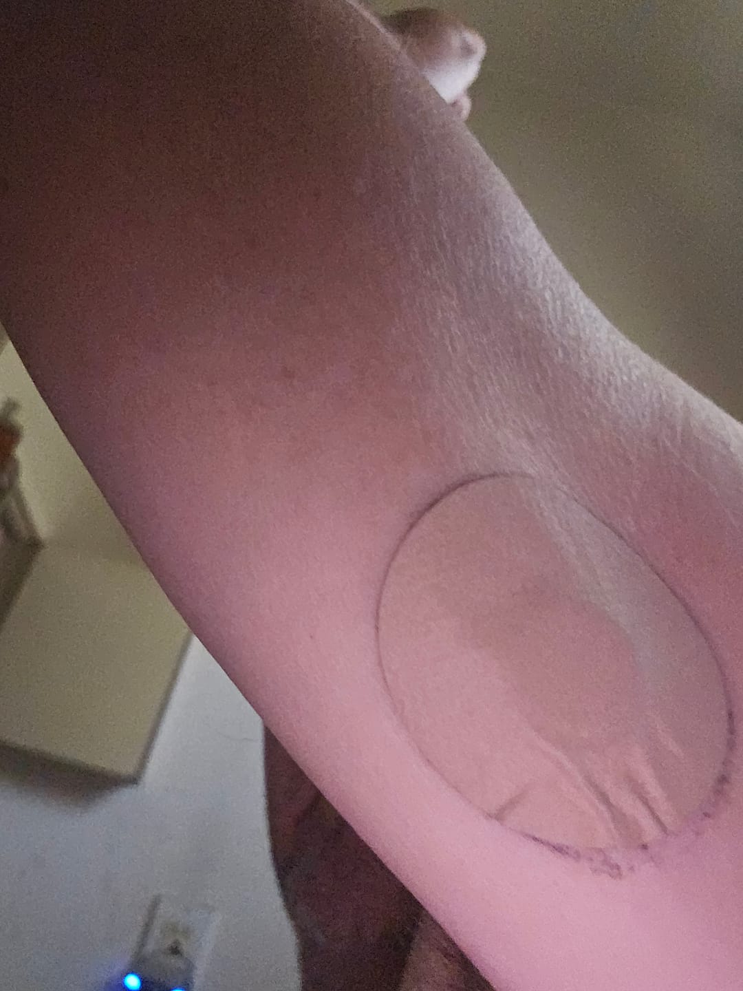 Customer photo review of Skin Grip MAX Freestyle Libre 3+ Patches - 10 Pack