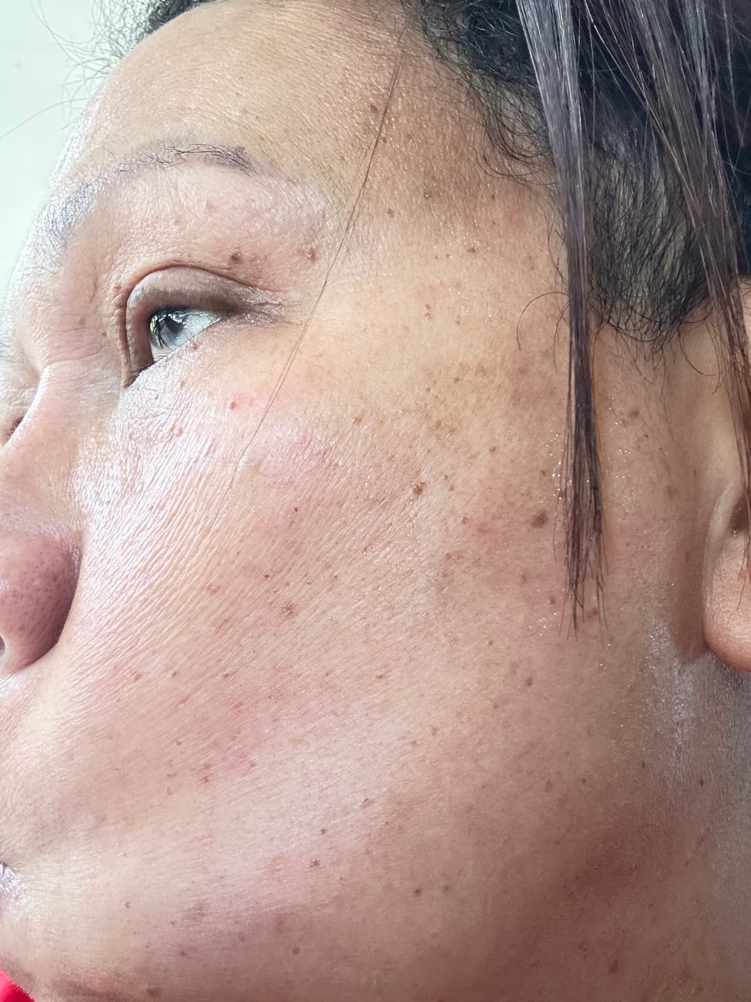 Customer photo review of The Viral Magnesium Super Stick™ — For Skin Tags, Moles, Keratosis & Blemishes