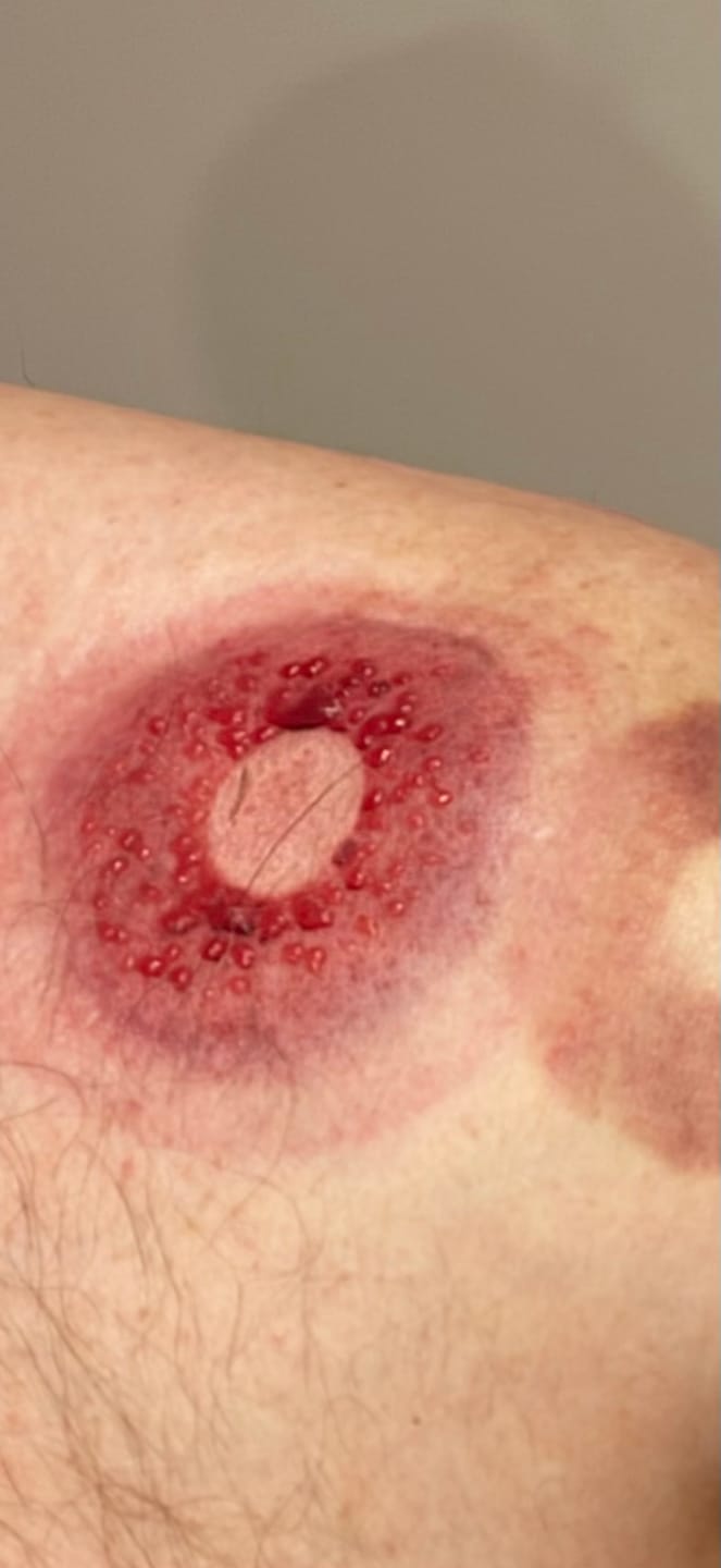 Customer photo review of The Pulse Cup™ Cupping Therapy Massager