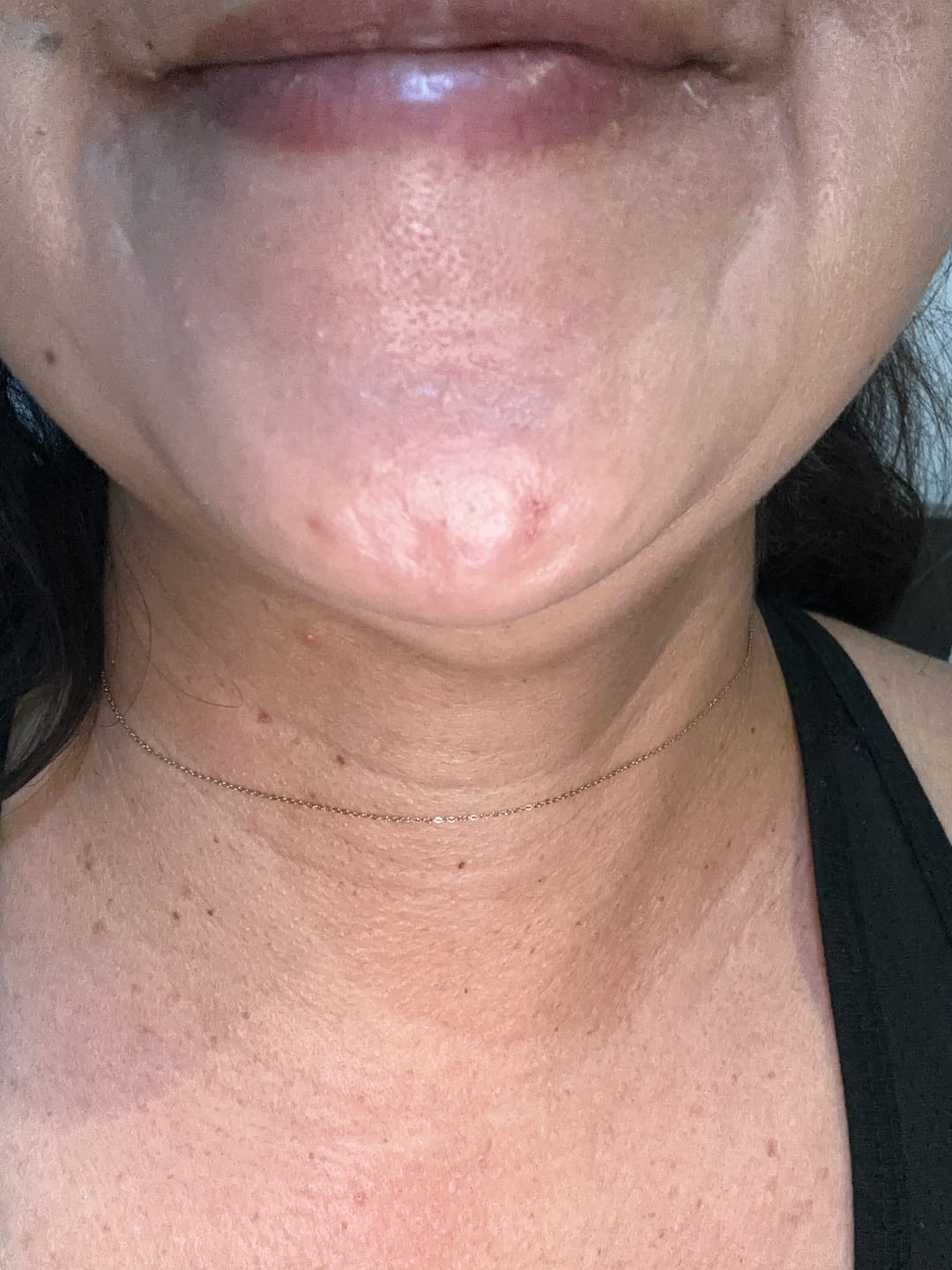 Customer photo review of A CONTROL - ACNÉ HORMONAL & RESISTENCIA A LA INSULINA