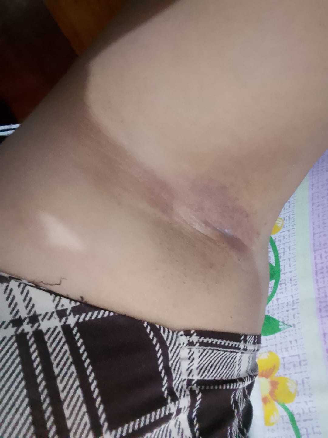 Customer photo review of Crema Aclarante para zonas íntimas Skinglow
