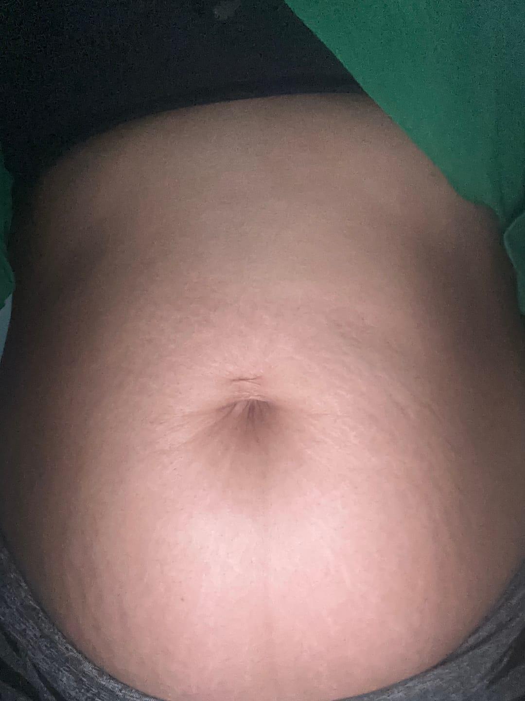 Customer photo review of Creme Antiestrias Regenerador Dérmico