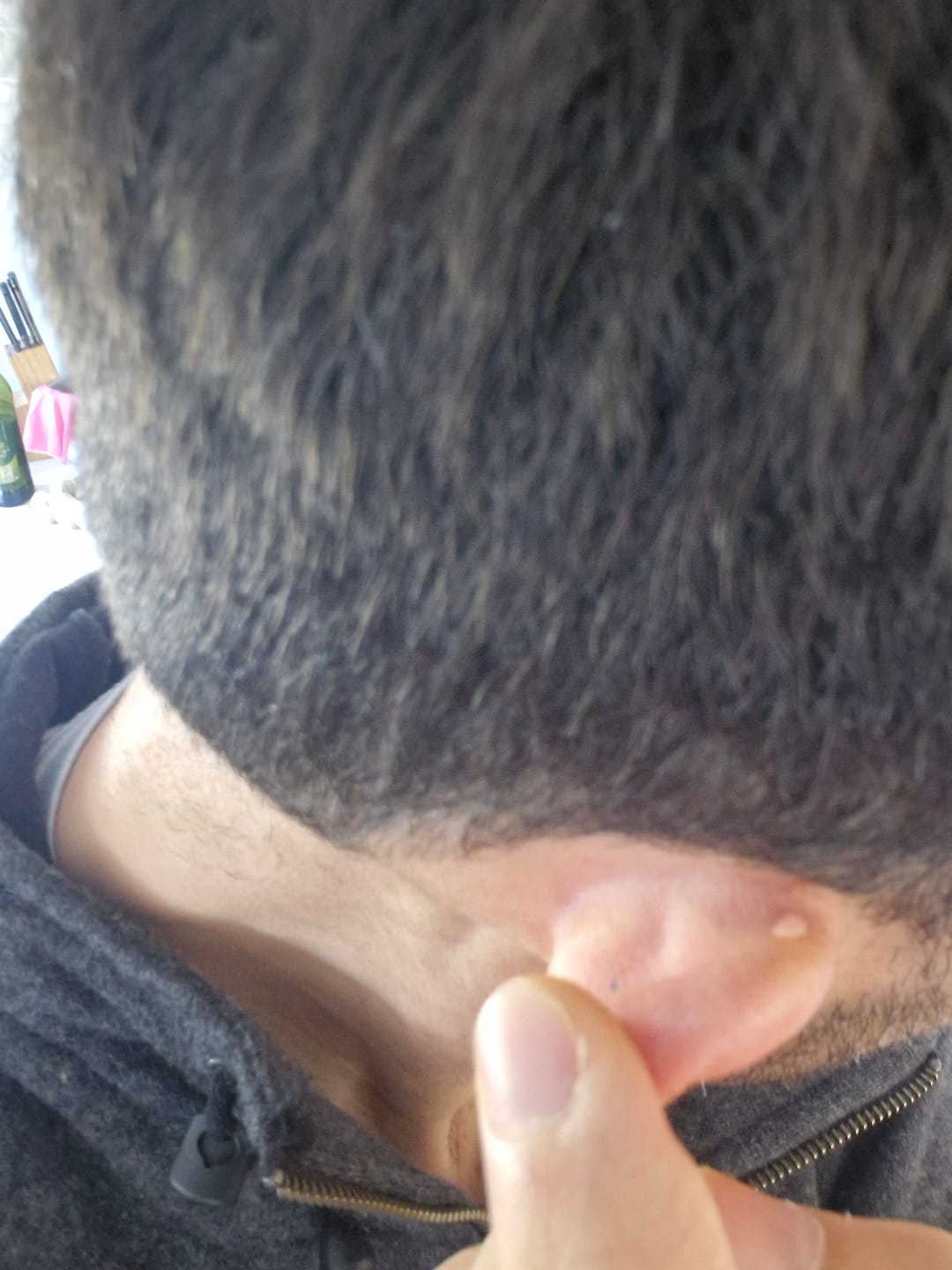 Customer photo review of The Viral Magnesium Super Stick™ — For Skin Tags, Moles, Keratosis & Blemishes