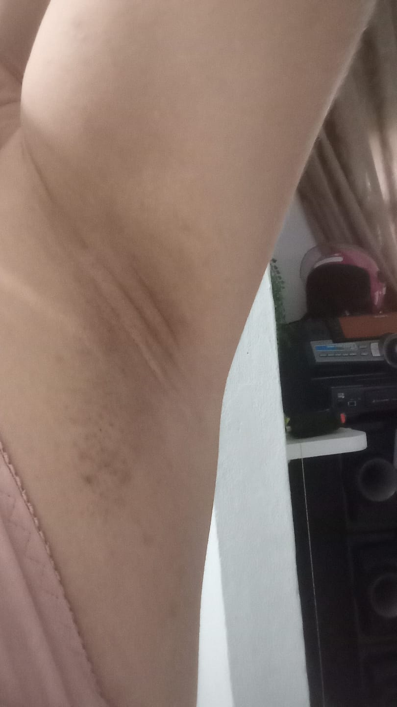 Customer photo review of Creme Clareador de Manchas – Melasma, Axilas, Virilha, Áreas Íntimas, Rosto e Corpo