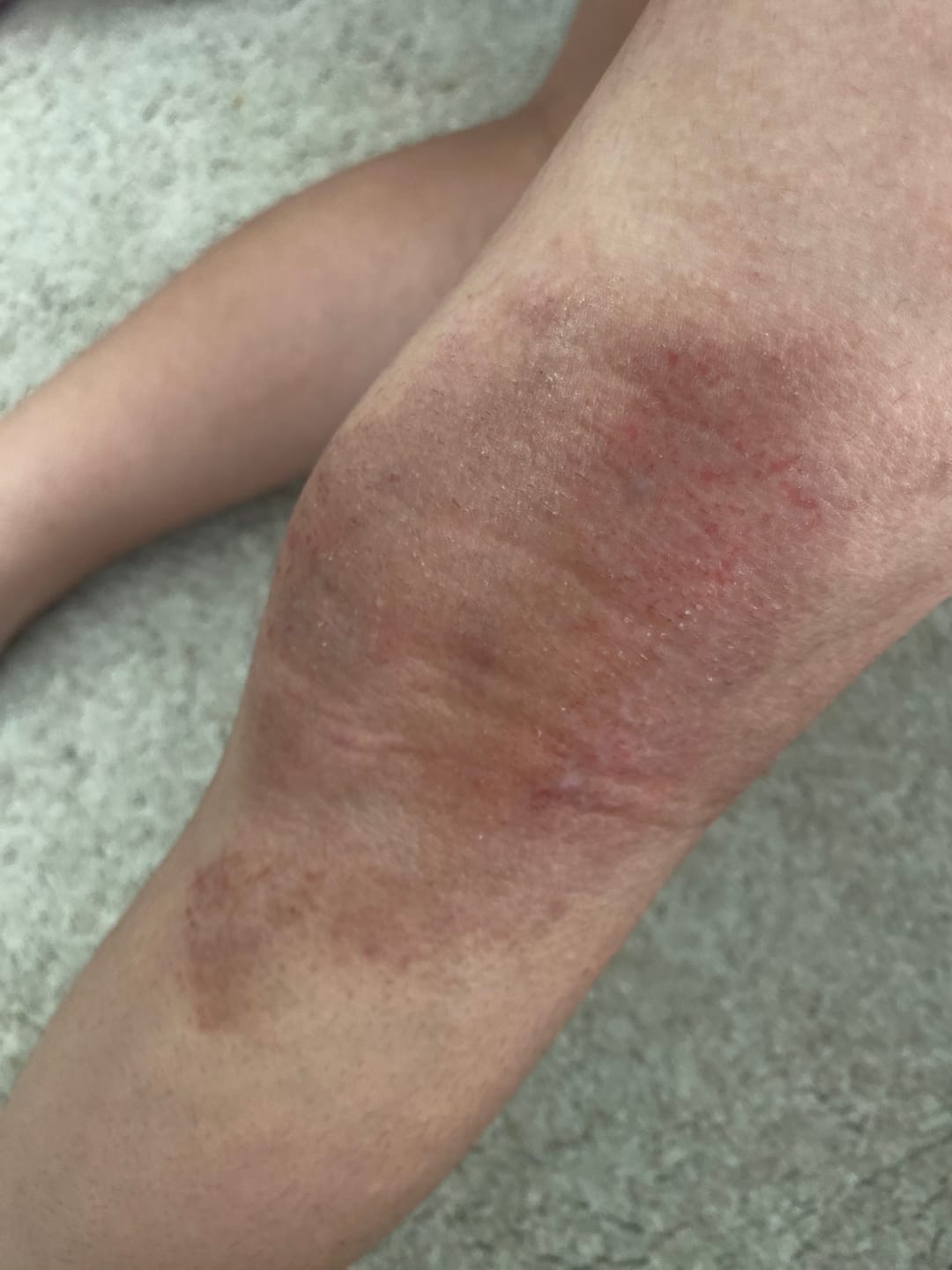 Customer photo review of Smiles & Joys Eczema and Psoriasis Herbal Cream
