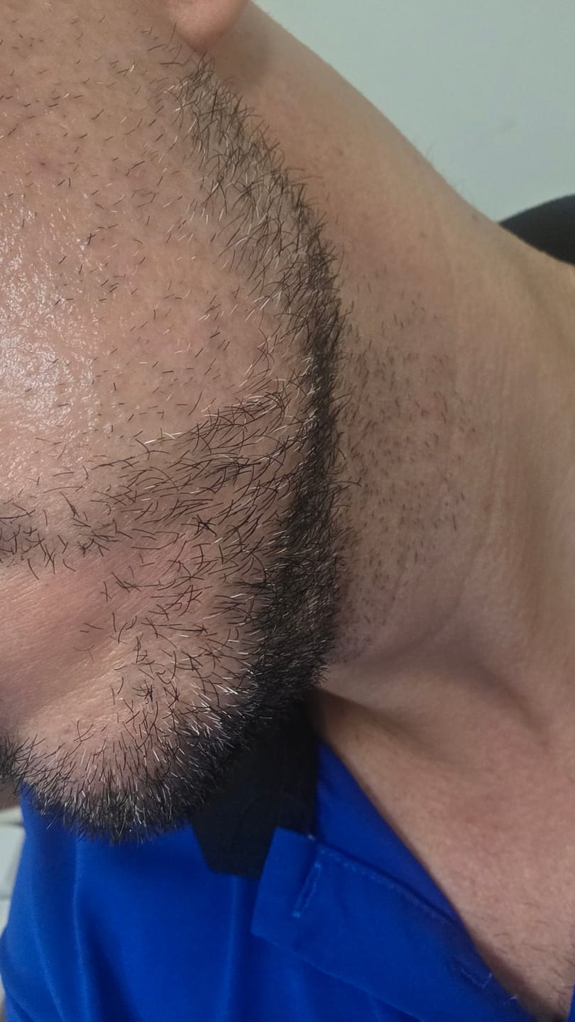 Customer photo review of Kit Barba Real | 2 Minoxidil al 20% +Biotina + Derma | El kit más Completo para crecimiento de Barba