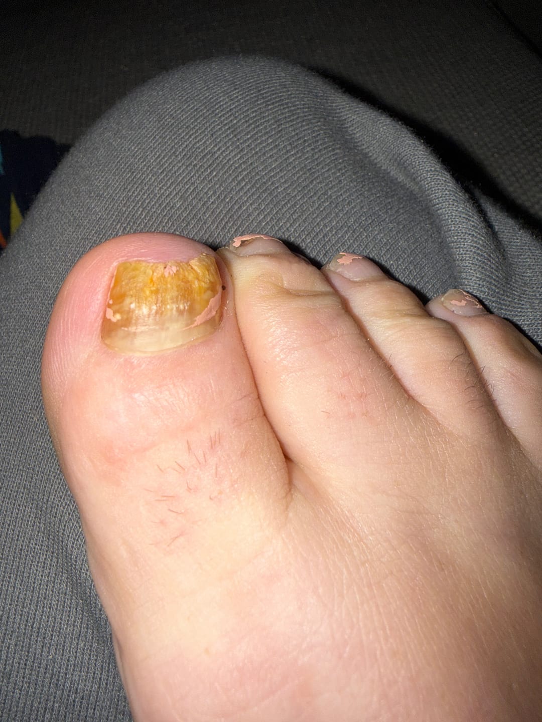 Customer photo review of Fungal Freedom