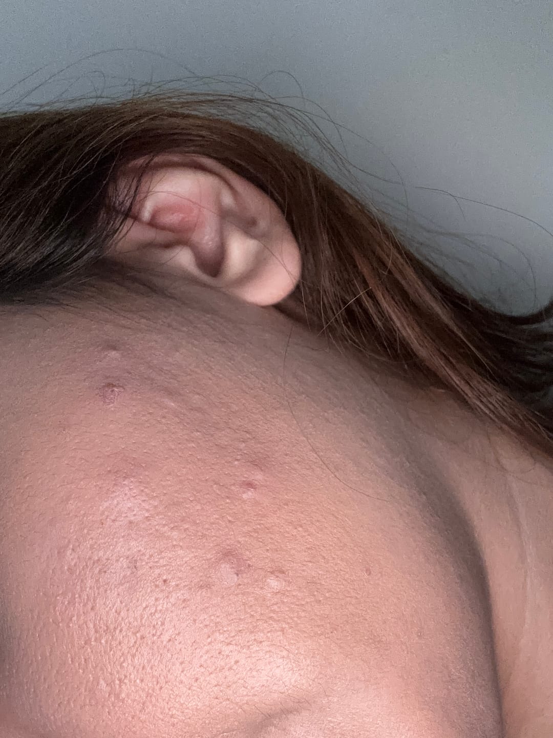 Customer photo review of A CONTROL - ACNÉ HORMONAL & RESISTENCIA A LA INSULINA