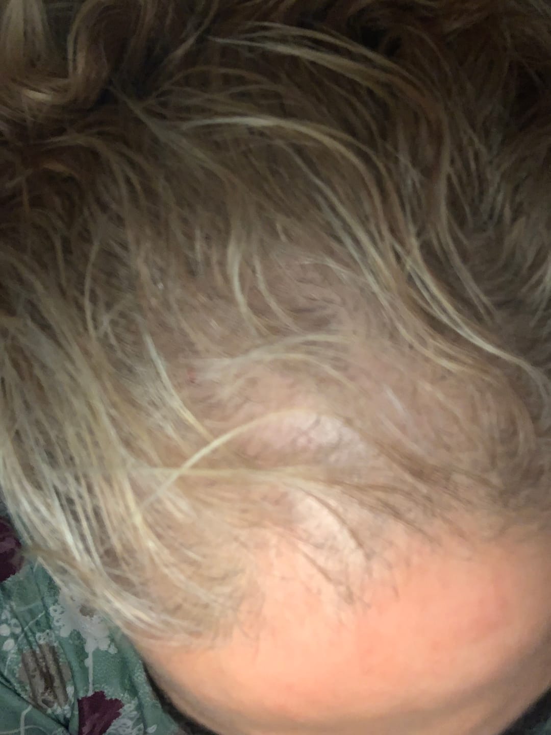 Customer photo review of VITAFOAM™ 5% Minoxidil Foam