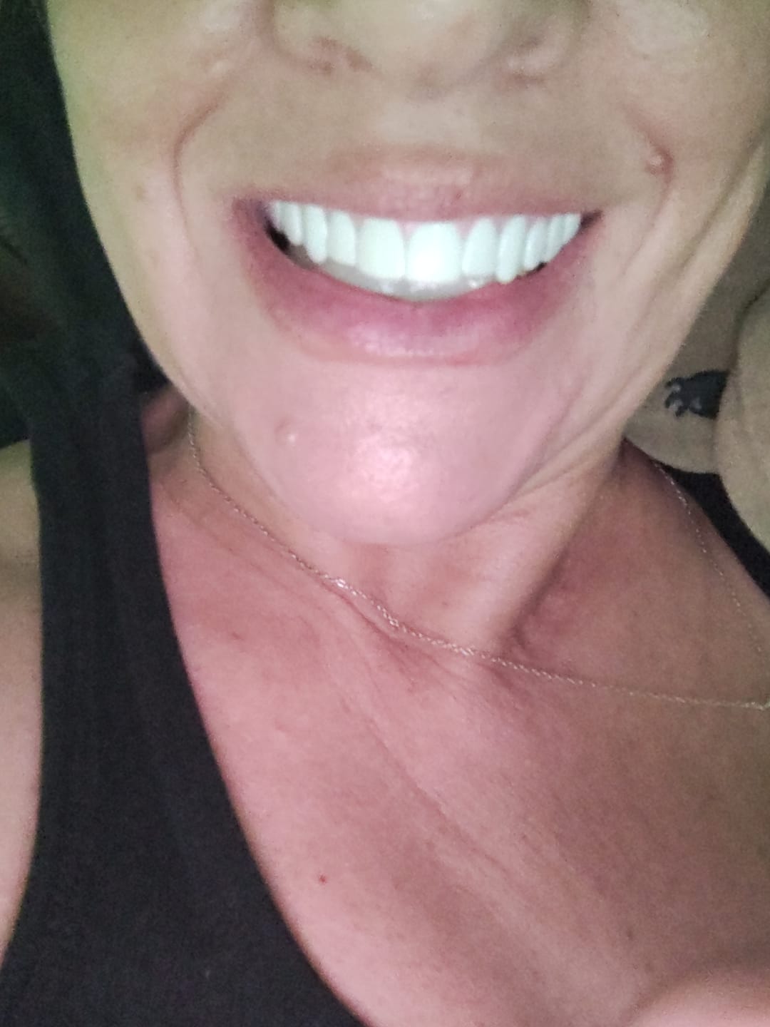 Customer photo review of Imako® Moldable Fitting Beads – Use for any Fake Teeth