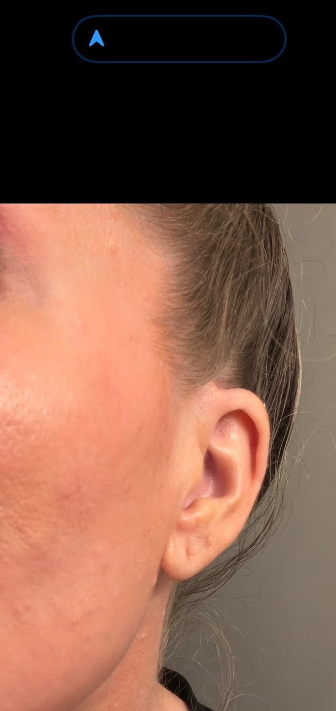 Customer photo review of ZERO-FIT Invisible Vitamin C Spot Patches