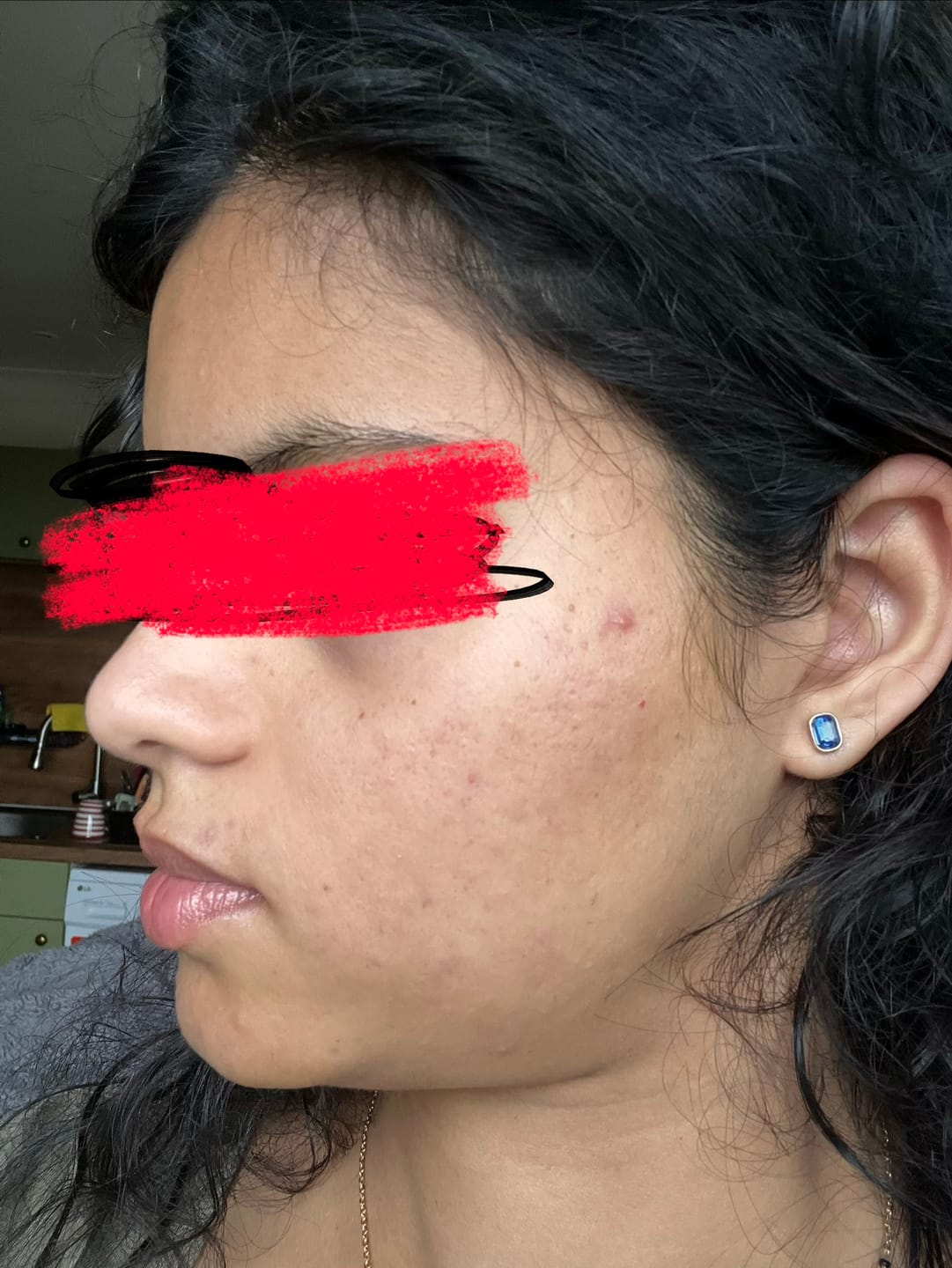 Customer photo review of The Complete System for Acne-Prone Skin