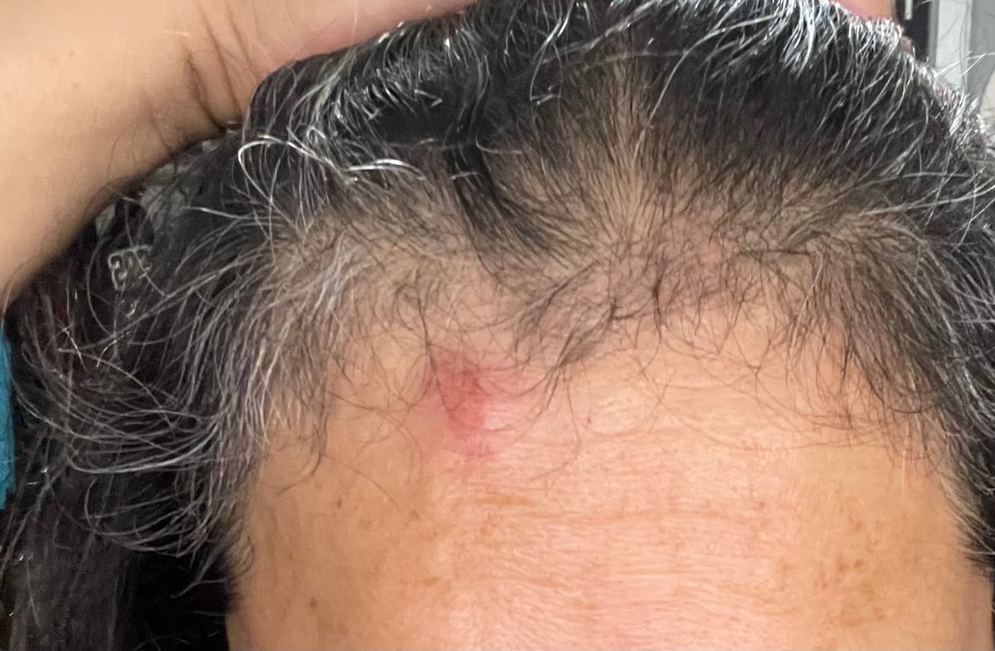Customer photo review of Glov Hair Regrowth Scalp Spray