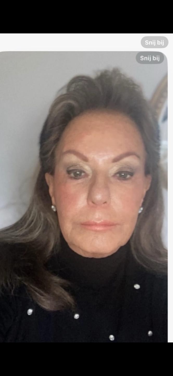 Customer photo review of Rosalique 3 in 1 Anti-Redness Miracle Formula SPF50