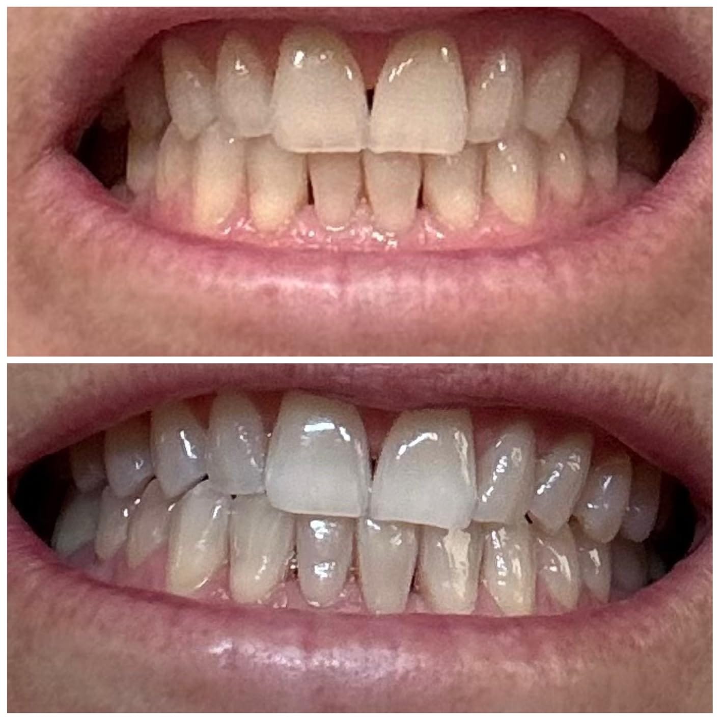 Customer photo review of Toothly™ Peptide Whitening Strips (For Sensitive Teeth)