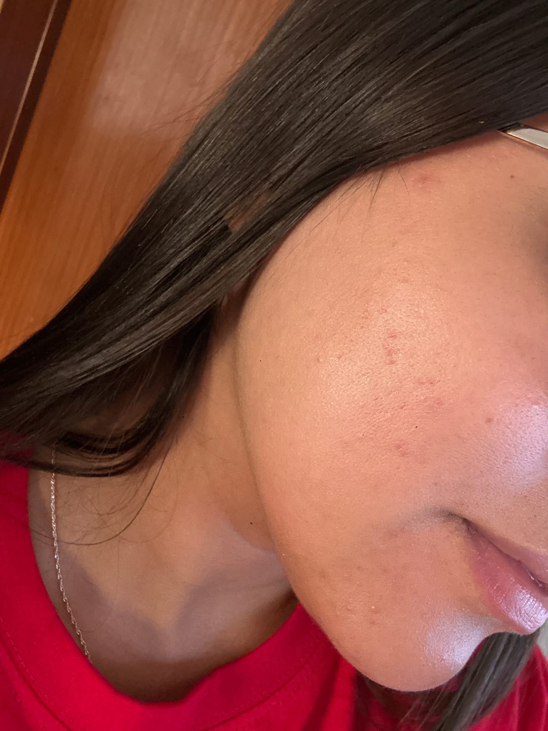 Customer photo review of A CONTROL - ACNÉ HORMONAL & RESISTENCIA A LA INSULINA