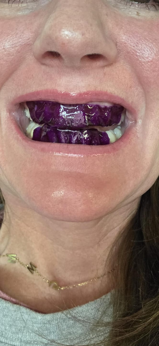 Customer photo review of Toothly™ Peptide Whitening Strips (For Sensitive Teeth)