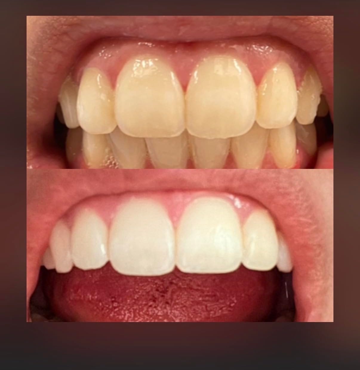 Customer photo review of Toothly™ Peptide Whitening Strips (For Sensitive Teeth)