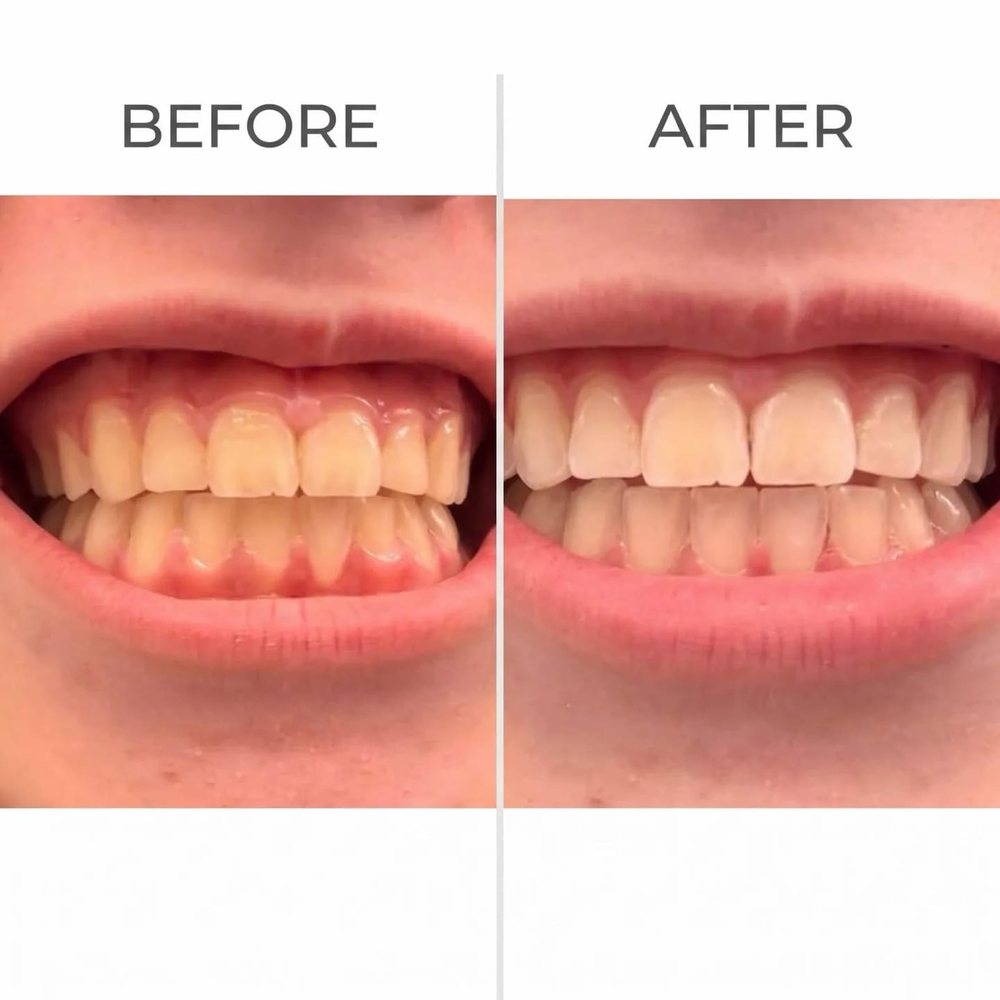 Customer photo review of Toothly™ Peptide Whitening Strips (For Sensitive Teeth)