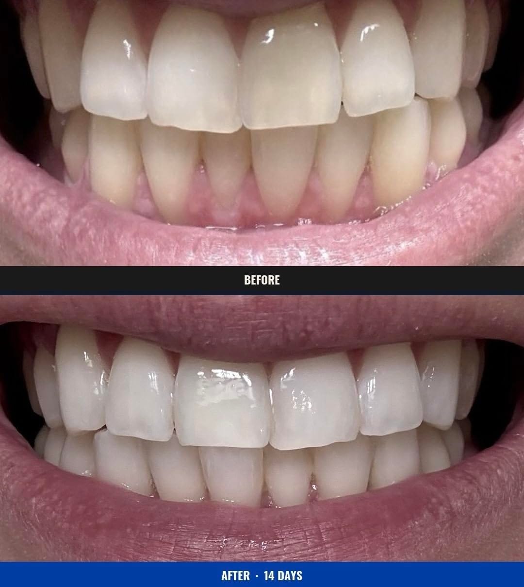 Customer photo review of Toothly™ Peptide Whitening Strips (For Sensitive Teeth)
