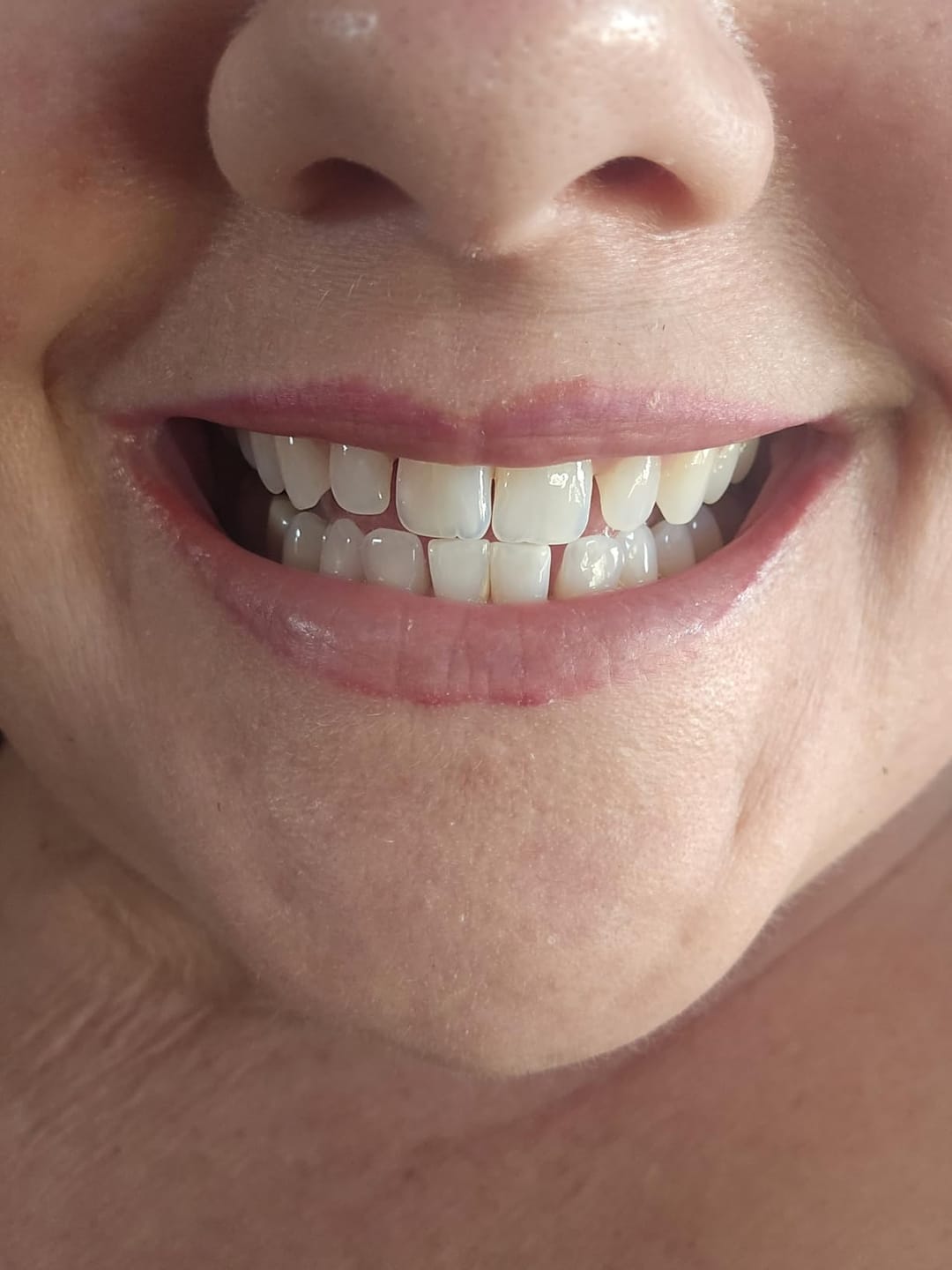 Customer photo review of Toothly™ Peptide Whitening Strips (For Sensitive Teeth)
