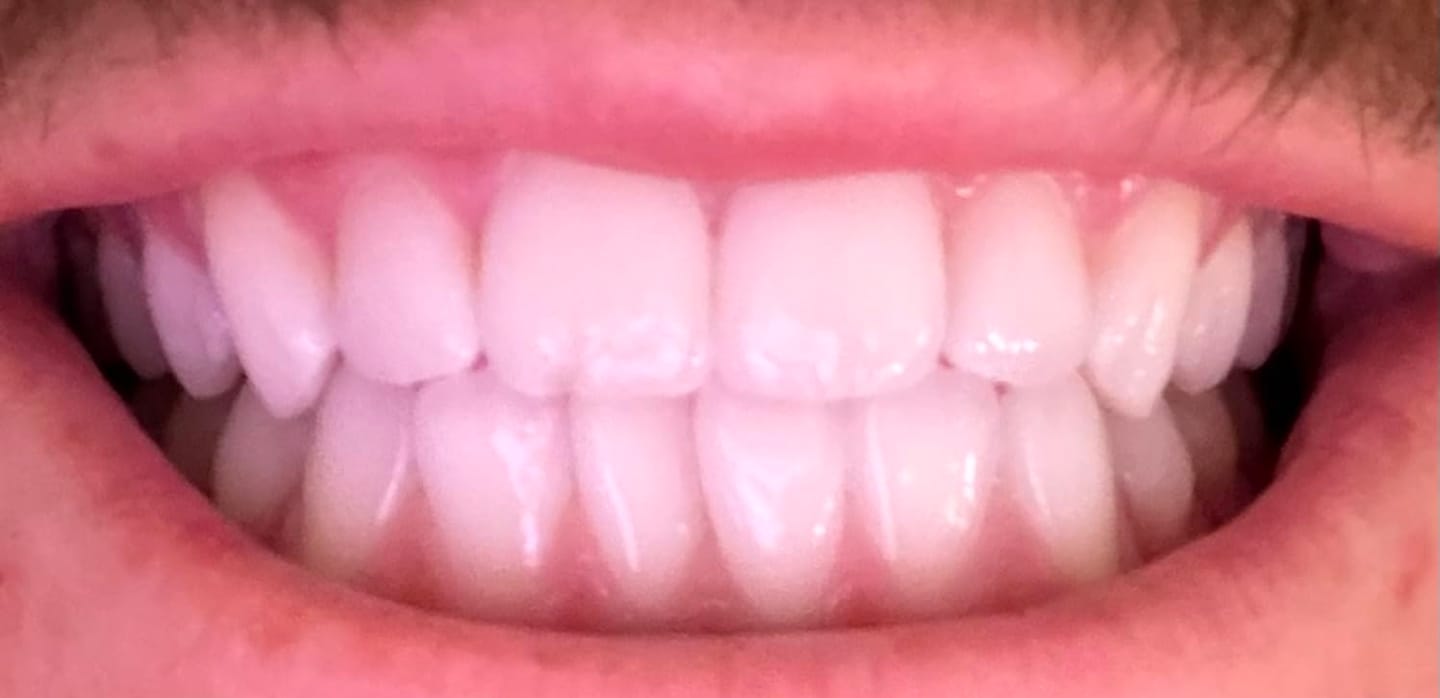 Customer photo review of Toothly™ Peptide Whitening Strips (For Sensitive Teeth)