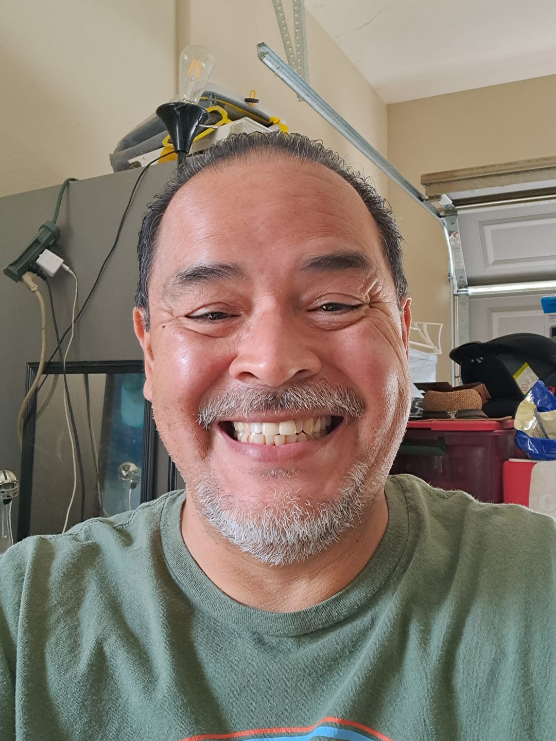 Customer photo review of Flexible Partial Denture
