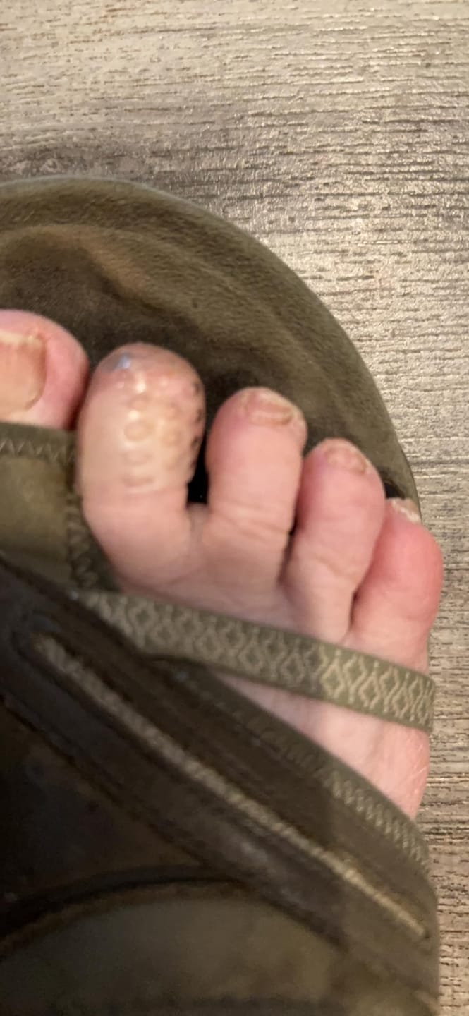 Customer photo review of ANTI-CHAFE TOE SLEEVES