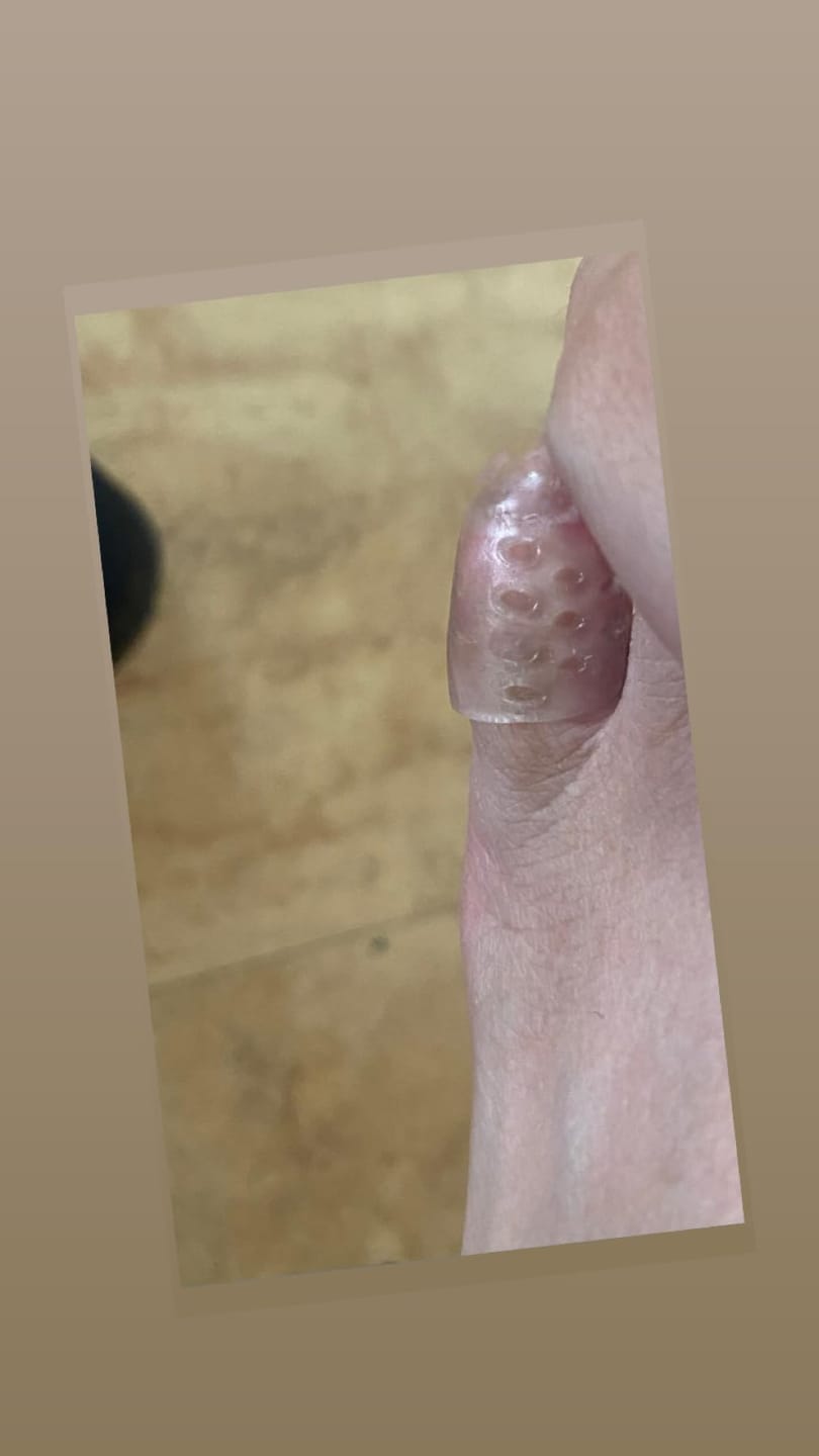Customer photo review of ANTI-CHAFE TOE SLEEVES