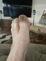 Customer photo review of ANTI-CHAFE TOE SLEEVES