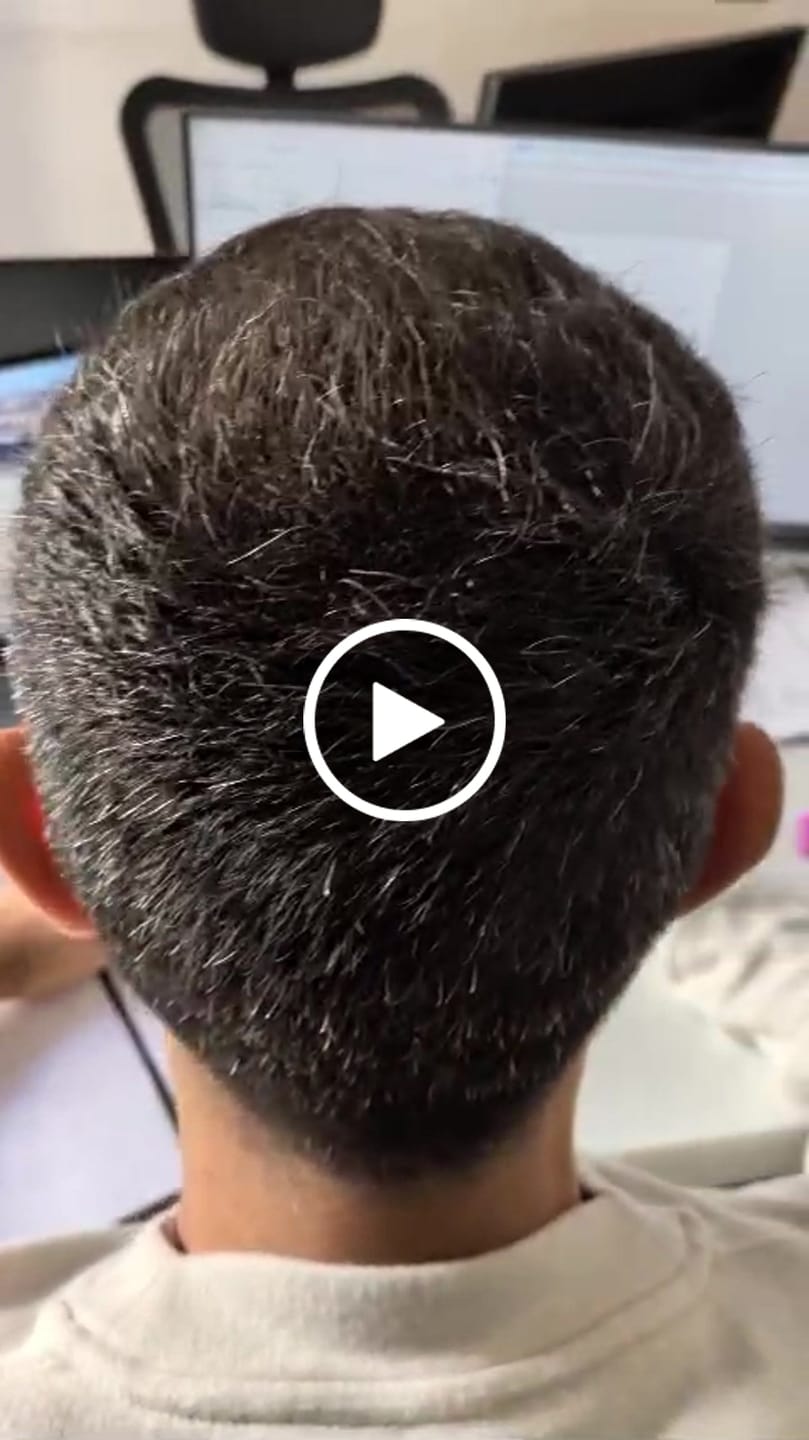 Customer video review of HairFiberPlus – Fibre di Cotone per Capelli 27,5g | Grigio | Copri Diradamento (~60 giorni)