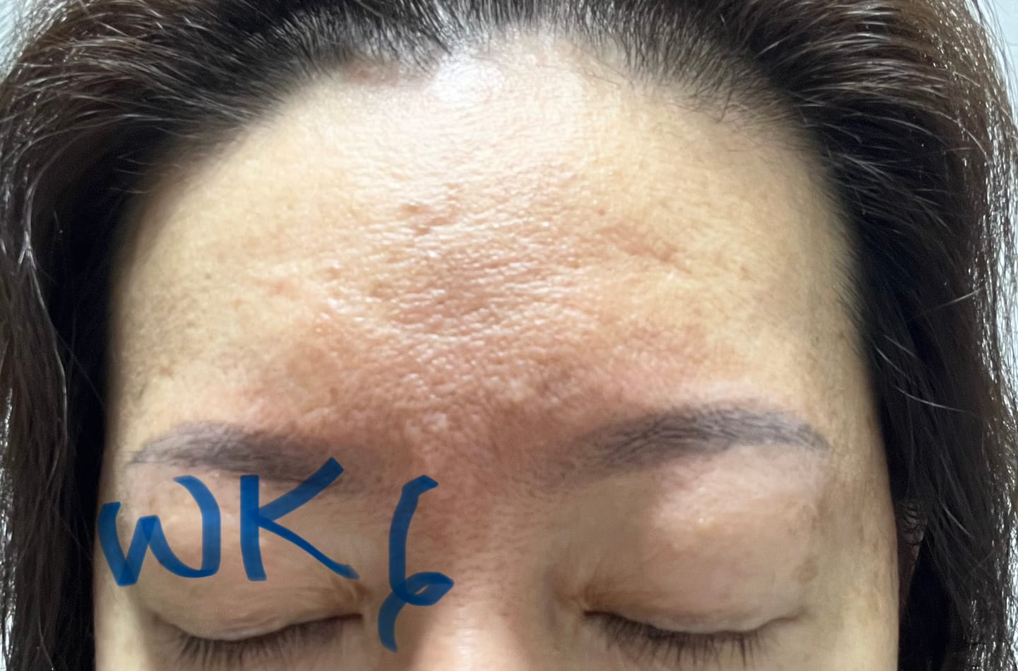 Customer photo review of Ventamin Light Up: Doctor-Formulated Brightening Formula for Melasma, Acne scars & Hyperpigmentation