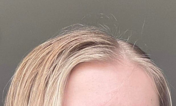 Customer photo review of The Magic Hair Growth Serum with Derma-Roller Applicator - Copper Peptide and Capixyl - Non Greasy Serum