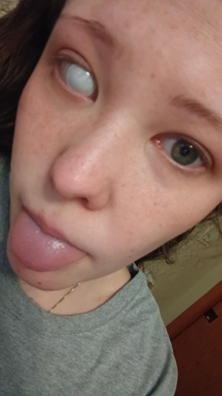 Customer photo review of Halloween White out Colored Contact Lenses