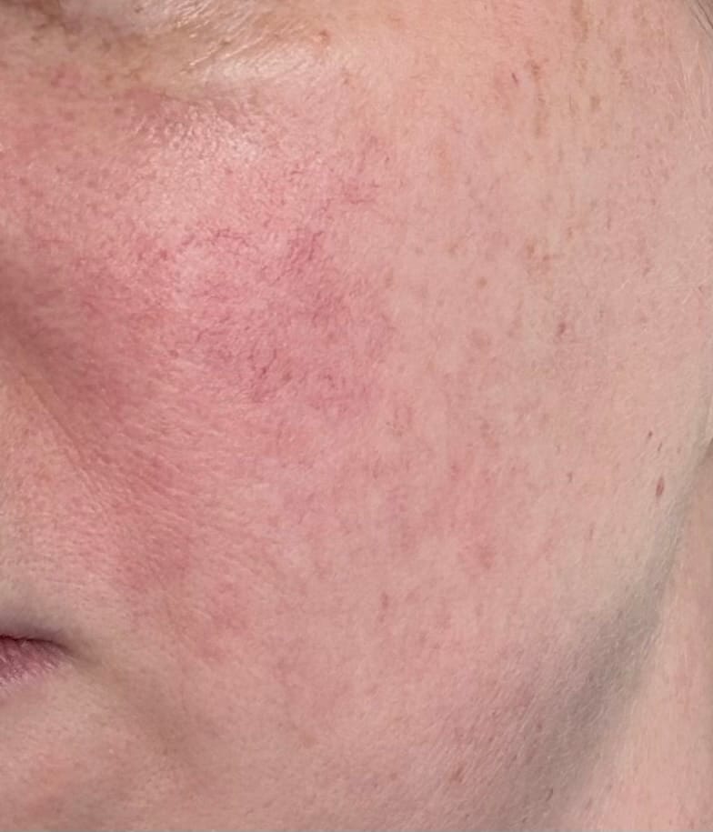 Customer photo review of Rosalique 3 in 1 Anti-Redness Miracle Formula SPF50