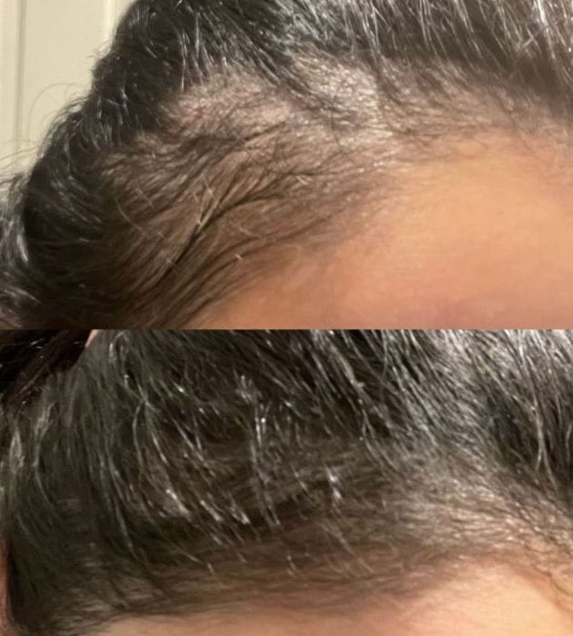 Customer photo review of The Magic Hair Growth Serum with Derma-Roller Applicator - Copper Peptide and Capixyl - Non Greasy Serum