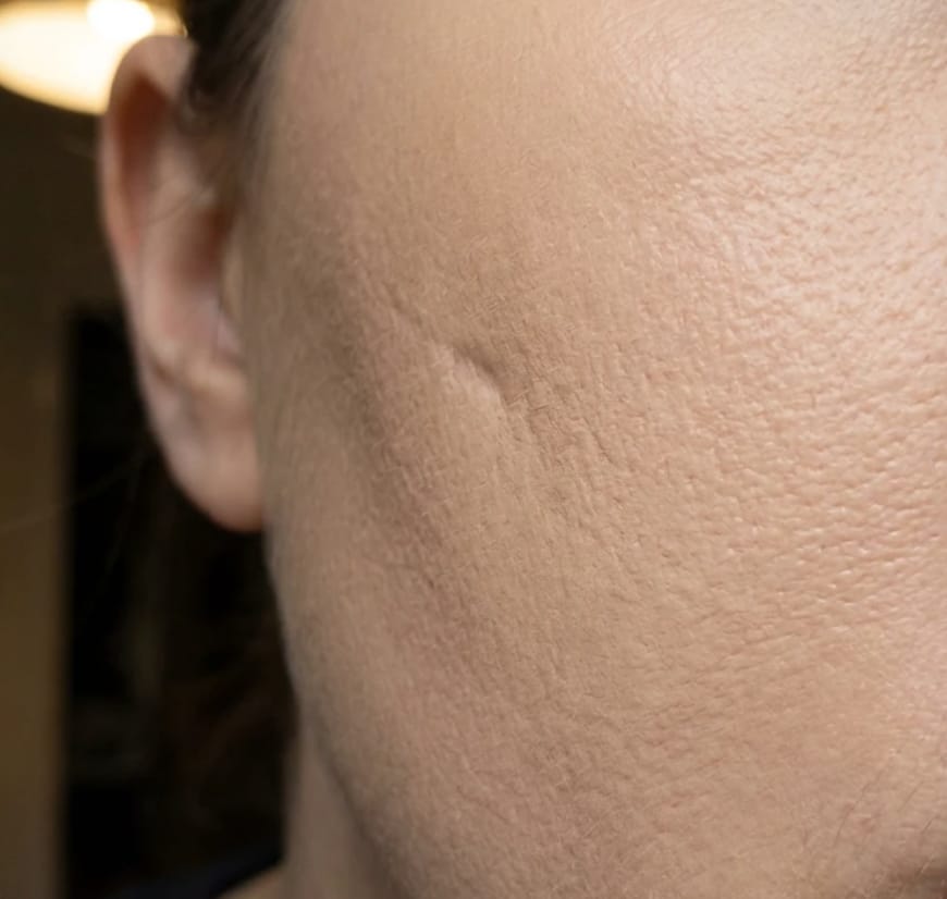 Customer photo review of ScarSilk™ - Stick al Silicone Medicale per Cicatrici da Acne
