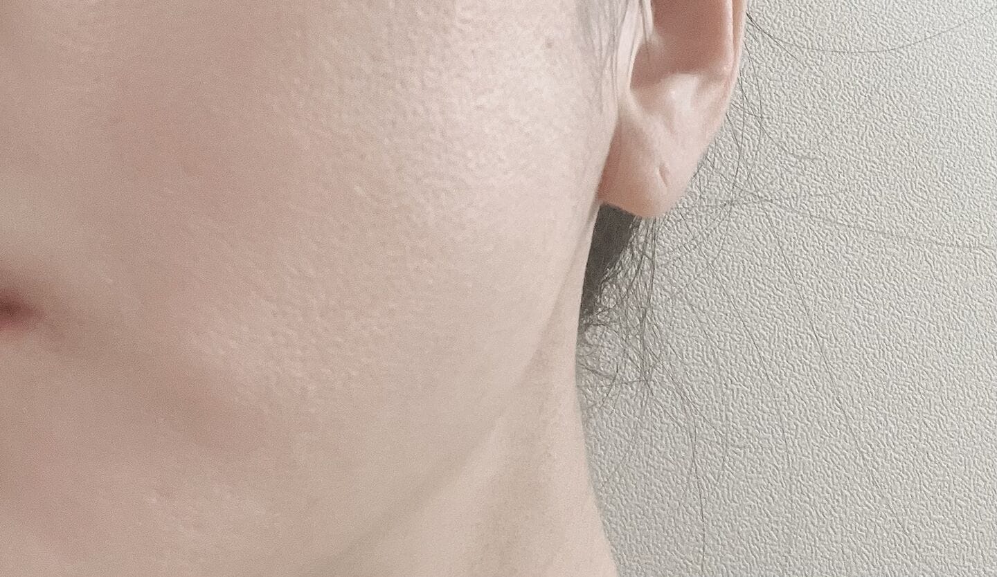 Customer photo review of Skin Blemish Balm Intensive (6 Shades)