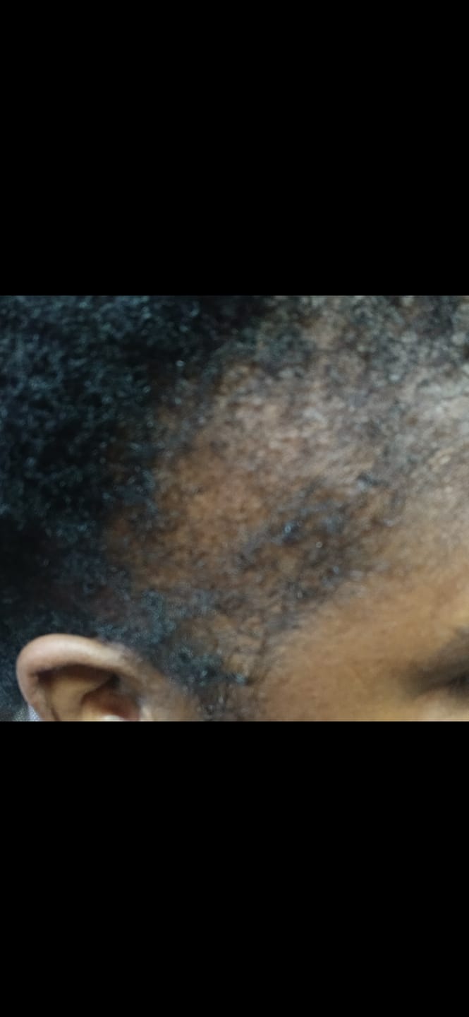 Customer photo review of Hair & Hairline Growth Serum Set