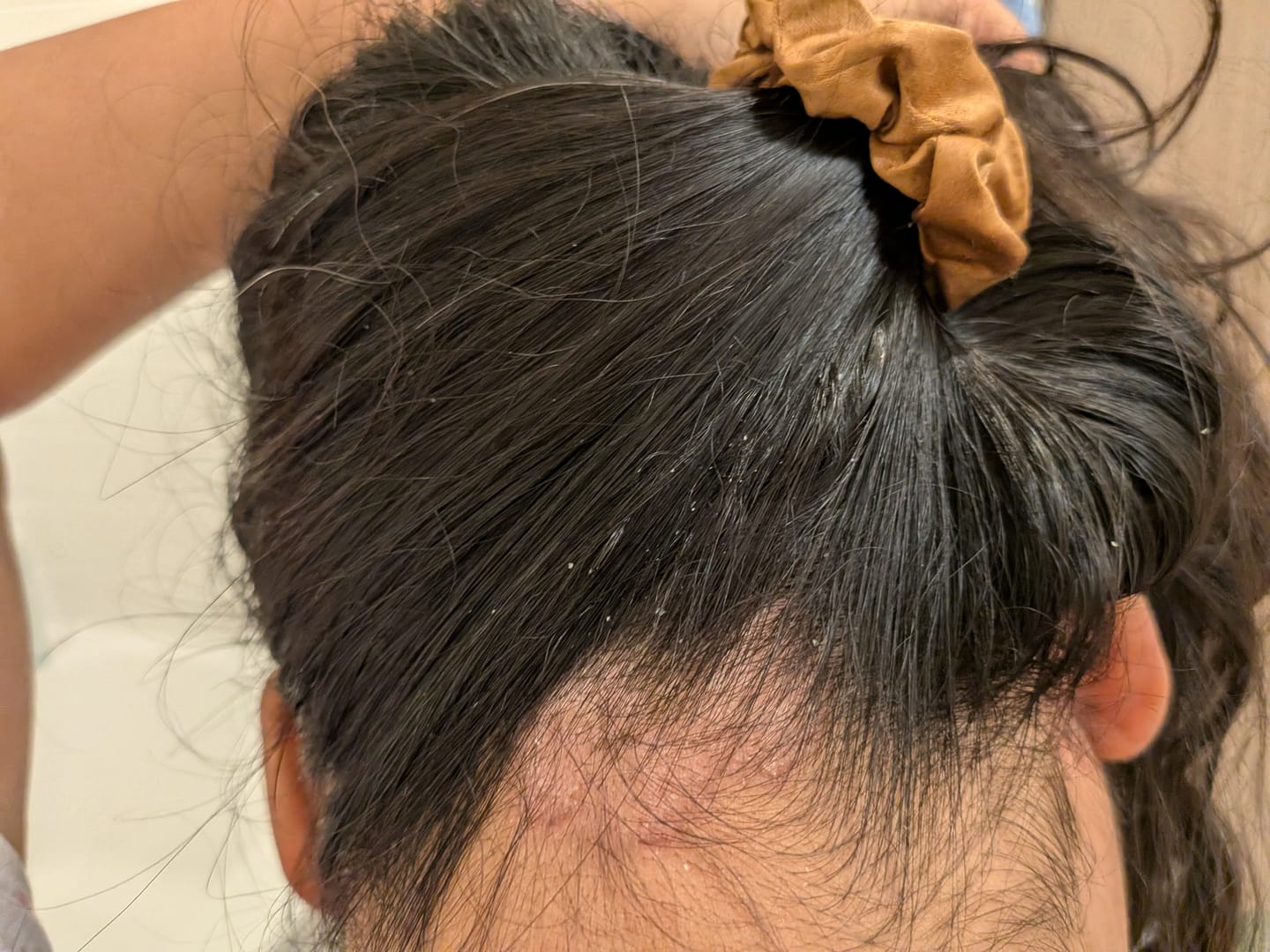 Customer photo review of Psoriasis Honey Scalp Nourishing Kit