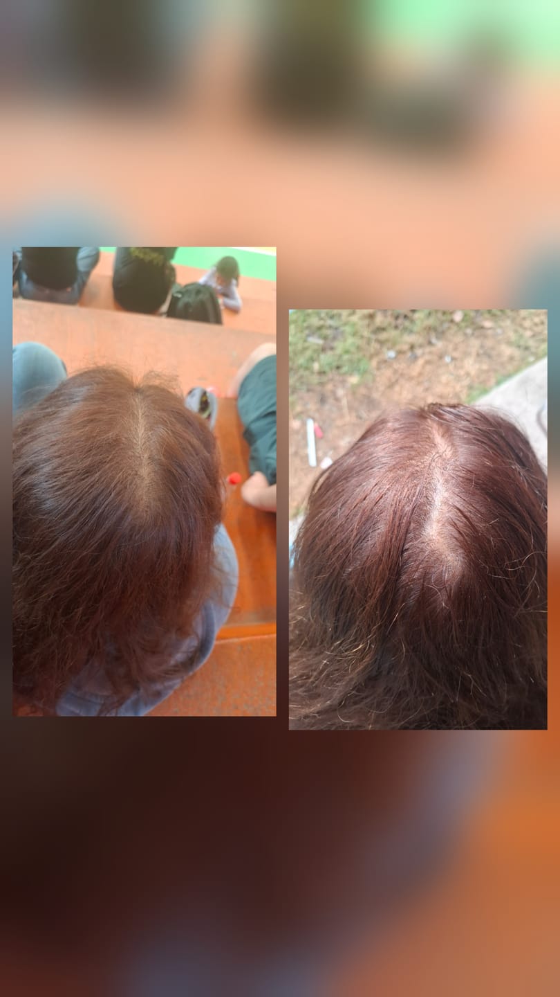 Customer photo review of 3 MESES de DUO ANTIcaída capilar 3 TÓNICOS + 90caps BOMBA NUTRICIONAL | ENVÍO GRATIS
