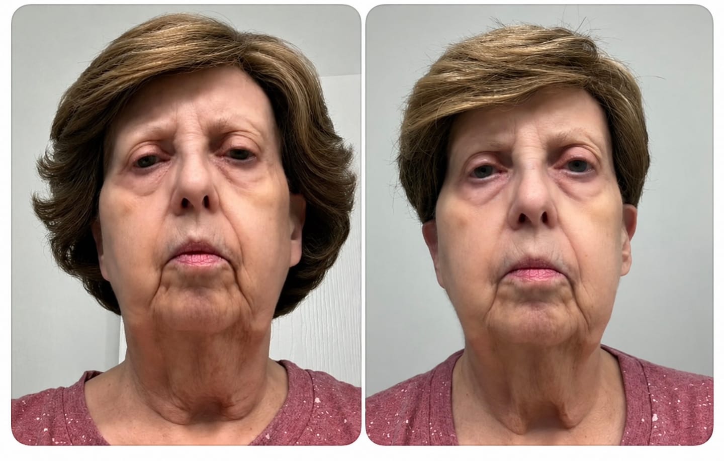 Customer photo review of Micro Infusion Patches