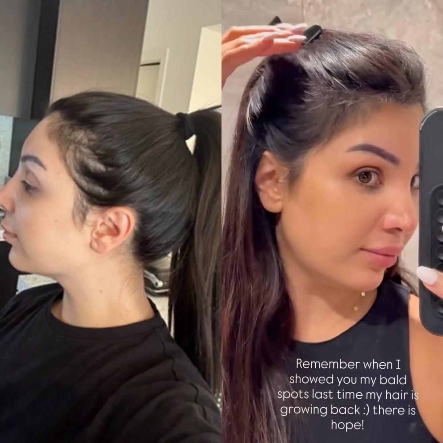 Customer photo review of The Magic Hair Growth Serum with Derma-Roller Applicator - Copper Peptide and Capixyl - Non Greasy Serum
