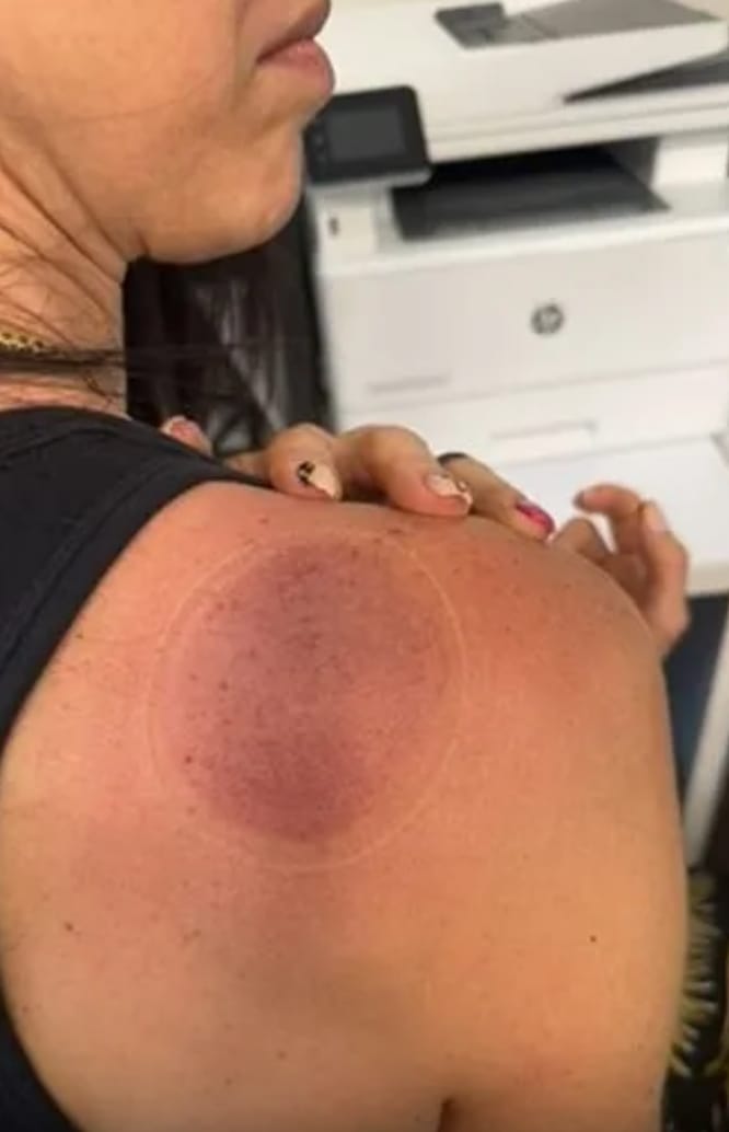 Customer photo review of VORA™ Terapia con Ventosas Inteligentes