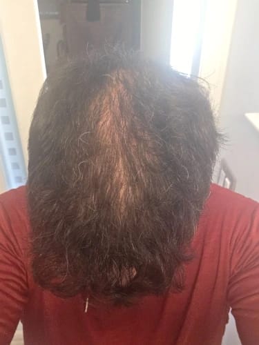 Customer photo review of Peptide Infusion Hair Regrowth System