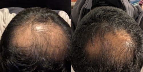 Customer photo review of Peptide Infusion Hair Regrowth System